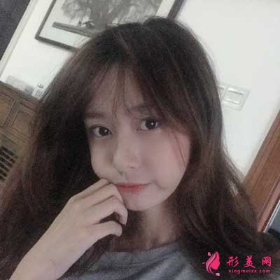 在珠海九龍找王繼紅做的隆鼻 終于擁有了高挺鼻子 效果真好！