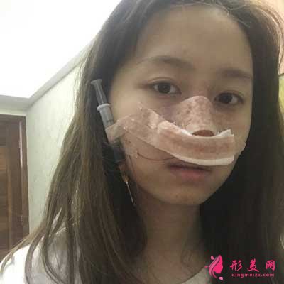 到珠海九龍做隆鼻整形手術(shù)的術(shù)后當(dāng)天