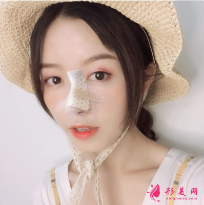 生命加醫(yī)療美容醫(yī)院做鼻子怎么樣？假體隆鼻術(shù)后90天效果真的好