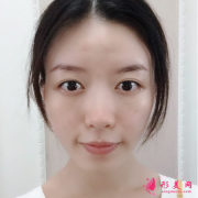 西安西京醫(yī)院美容科哪位醫(yī)生做鼻子比較好？隆鼻案例