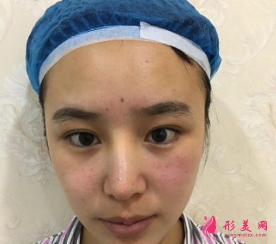 北醫(yī)三院馬勇光做雙眼皮怎么樣？30天術后恢復效果真的非常不錯