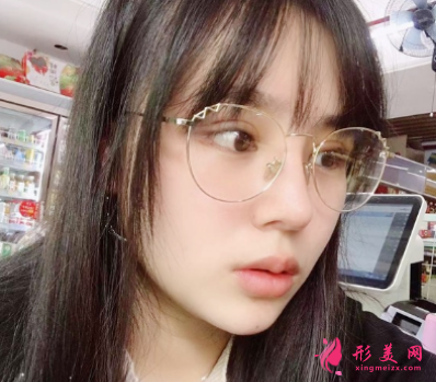 北醫(yī)三院馬勇光做雙眼皮怎么樣？30天術后恢復效果真的非常不錯
