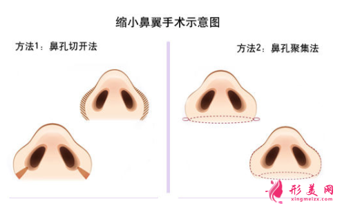 做鼻翼縮小手術(shù)安全嗎