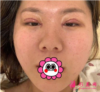 成都米蘭柏羽吳江山做雙眼皮怎么樣？48天前后對比圖案例分享