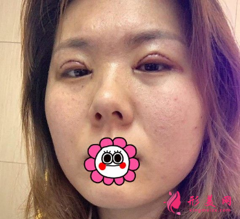 成都米蘭柏羽吳江山做雙眼皮怎么樣？48天前后對比圖案例分享