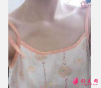 廣州海峽整形醫(yī)院怎么樣？周旭剛隆胸做的好嗎？周旭剛隆胸案例分