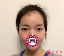 杭州藝星整形樸正馨做雙眼皮手術(shù)怎么樣？樸正馨雙眼皮案列分享
