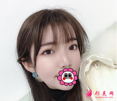杭州藝星整形樸正馨做雙眼皮手術(shù)怎么樣？60天前后對比圖案例分享