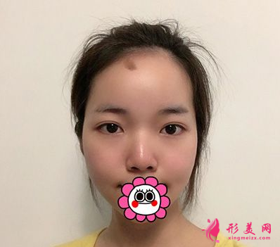 杭州藝星整形樸正馨做雙眼皮手術(shù)怎么樣？60天前后對比圖案例分享