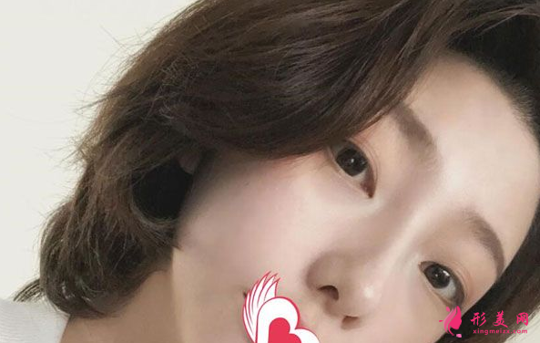 杭州格萊美熊滔醫(yī)師真人隆鼻案例 90天前后對比蛻變分享