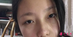 杭州格萊美熊滔做隆鼻好不好？熊滔隆鼻案列分享
