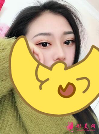 深圳羅金剛雙眼皮案例，術(shù)后變化就是這么大！