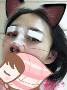 深圳羅金剛雙眼皮怎么樣？，雙眼皮術(shù)后分享，變化就是這么大！