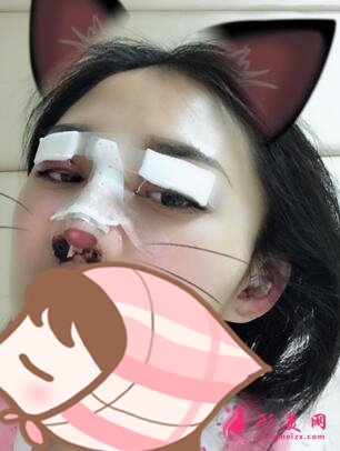 深圳羅金剛雙眼皮案例，術(shù)后變化就是這么大！