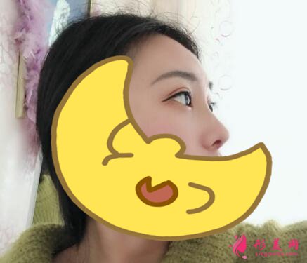 深圳羅金剛雙眼皮案例，術(shù)后變化就是這么大！