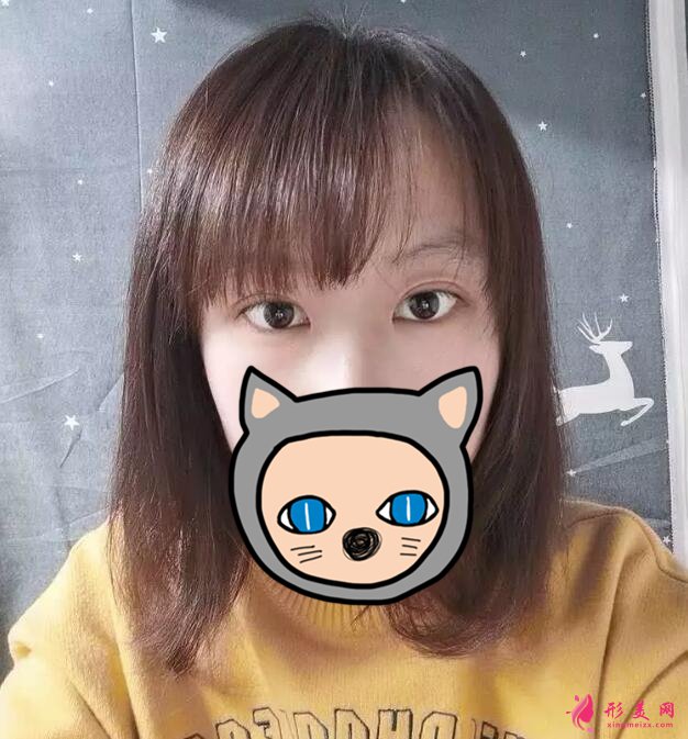 深圳葉琳雙眼皮案例，把小姐姐的美分享給大家
