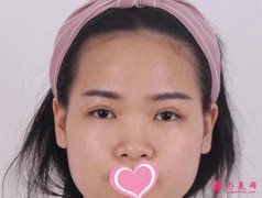 濟(jì)南省立醫(yī)院做鼻子怎么樣？隆鼻案例分享