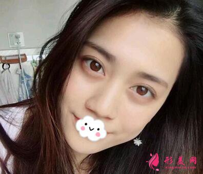 深圳美加美陳群雙眼皮手術術后三個月