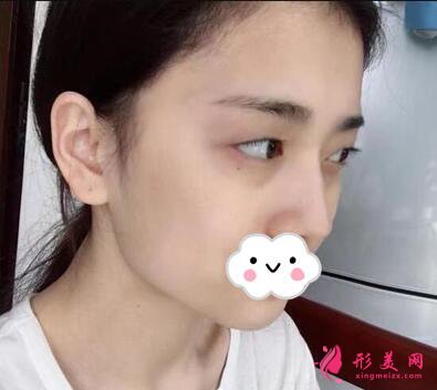深圳美加美陳群雙眼皮手術術前