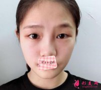 廣州紫馨醫(yī)療美容醫(yī)院雙眼皮怎么樣？雙眼皮手術(shù)案例分享