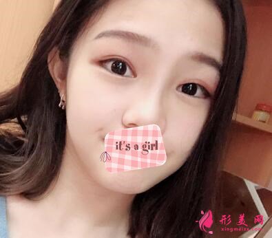 周國偉醫(yī)生做的雙眼皮手術(shù)術(shù)后第45天