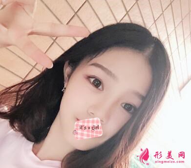 周國偉醫(yī)生做的雙眼皮手術(shù)術(shù)后第56天