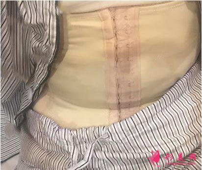 深圳嘉美醫(yī)療美容腰部抽脂手術(shù)術(shù)后第3天