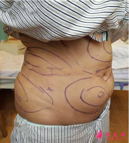 深圳嘉美醫(yī)療美容腰部抽脂手術(shù)術(shù)前