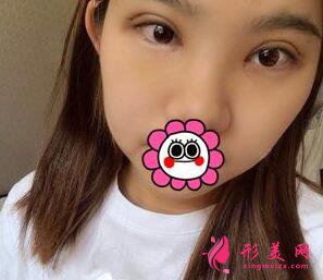 深圳yestar?？溯x雙眼皮手術(shù)術(shù)后第18天