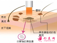 激光祛斑對皮膚有損傷嗎？