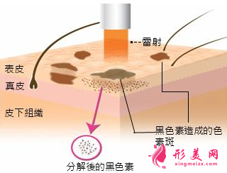激光祛斑對(duì)皮膚有損傷嗎