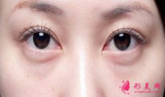 吸脂祛眼袋手術(shù)安全嗎？