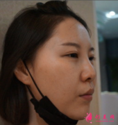 西安葉子整形醫(yī)院隆鼻價格表和真人真實案例分享