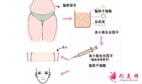 脂肪墊下巴能保持多長時間?