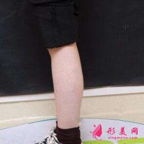botox瘦腿針是什么?