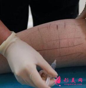 botox瘦腿針是什么?