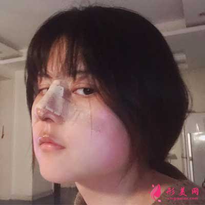 在沈陽人民整形醫(yī)院做的鼻子 術(shù)后第2天照片分享