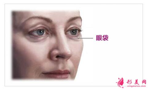 內(nèi)切祛眼袋手術(shù)后的注意事項(xiàng)