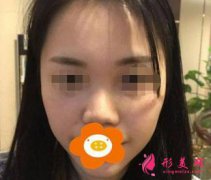 深圳歐亞美醫(yī)療美容怎么樣？口碑好不好？隆鼻案例分享