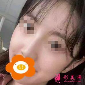 隆鼻三個(gè)月后恢復(fù)效果很好，鼻子形態(tài)自然無(wú)痕