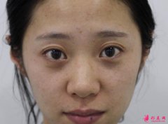 上海伊萊美做黑臉娃娃美白怎么樣？整形美容案例分享