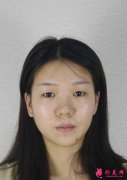 蘇州美貝爾整形美容醫(yī)院雙眼皮手術(shù)怎么樣？