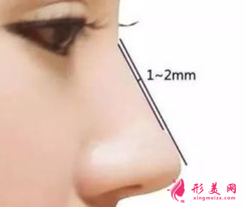 軟骨隆鼻手術(shù)會(huì)不會(huì)有后遺癥