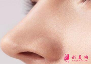 鼻尖整形手術(shù)特點(diǎn)到底是什么