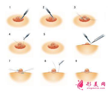 40歲可以做乳頭內(nèi)陷矯正嗎