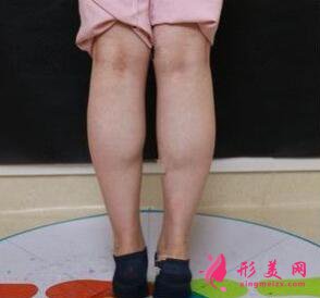 光纖溶脂瘦小腿效果