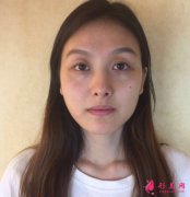 南京韓辰李德慶醫(yī)生隆鼻怎么樣？真人案例 分享