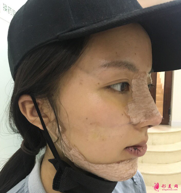西安美立方李旭平醫(yī)師真人隆鼻案例 35天前后對(duì)比圖分享
