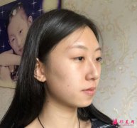 西安美立方李旭平醫(yī)師隆鼻做的怎么樣？真人案例分享