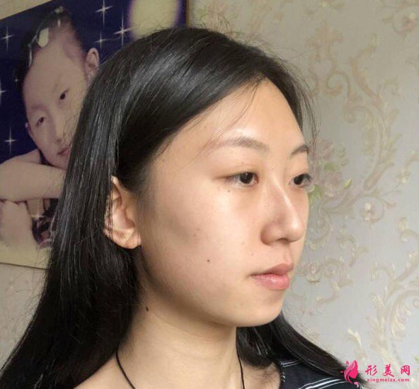 西安美立方李旭平醫(yī)師真人隆鼻案例 35天前后對(duì)比圖分享